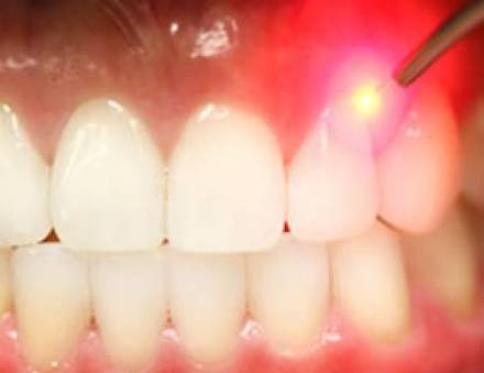 Root Canal Treatment in chennai 