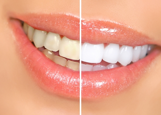 teeth-whitening-in-chennai
